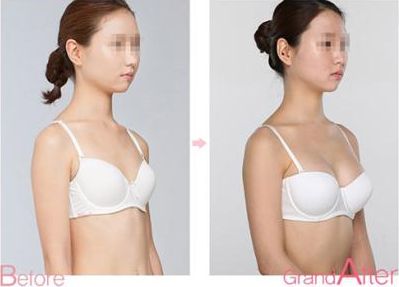 蘇州薇琳美容醫(yī)院吸脂手術(shù)效果如何？