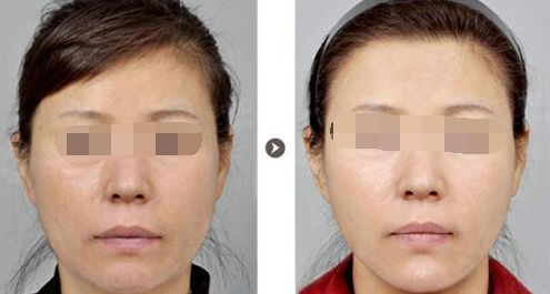 對比：Fotona 4D Pro與熱瑪吉除皺效果及持久性分析