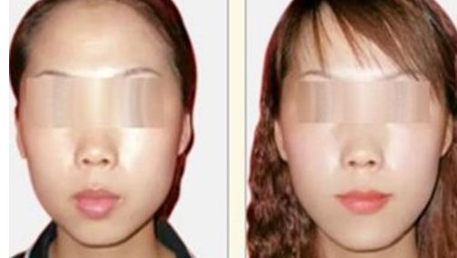 雙眼皮手術(shù)費(fèi)用2024全攻略：讓你美出新境界！