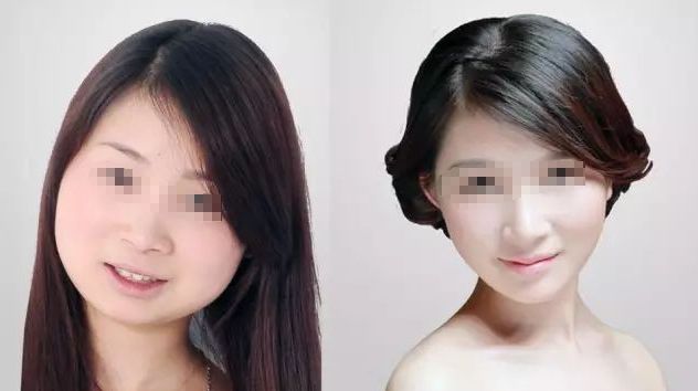 劉靖潔吸脂效果如何？天津麗人醫(yī)院專業(yè)技術(shù)引領(lǐng)