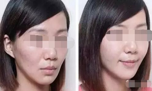 注射玻尿酸豐胸效果多久會(huì)消失？
