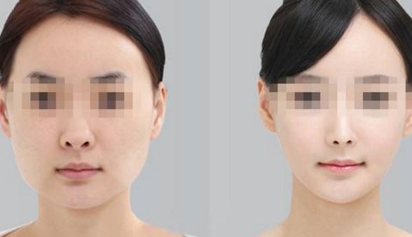 滄州京美雙眼皮價格與術(shù)后效果詳解