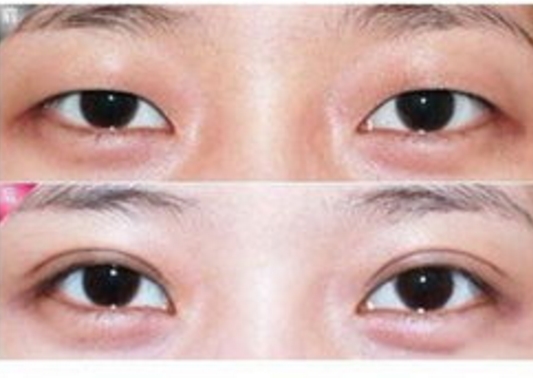 泰州痕焊接雙眼皮價(jià)目表放出(2023泰州痕焊接雙眼皮參考價(jià)為：6575元)