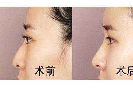 許昌聚能波環(huán)形吸脂術(shù)一次需要價(jià)格是多少費(fèi)用啊(2023許昌聚能波環(huán)形吸脂術(shù)參考價(jià)為：6663元)