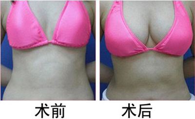 江蘇自體脂肪填充豐蘋果肌整形價格表預先一覽(2023江蘇自體脂肪填充豐蘋果肌參考價為：6001元)