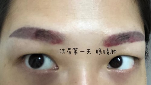 深圳臉上祛雀斑術價格表標準更新(2023深圳臉上祛雀斑術參考價為：6667元)