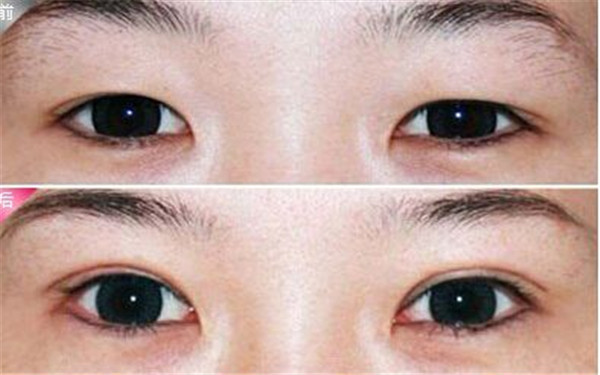 棗莊人工陰道費(fèi)用表明細(xì)(2023棗莊人工陰道參考價(jià)為：5322元)