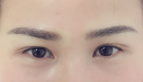 北京微針去除木偶紋收費價目趨勢圖一覽(2023北京微針去除木偶紋參考價為：5463元)