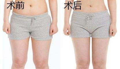 武漢秒雕祛法令紋報(bào)價(jià)多少價(jià)格(2023武漢秒雕祛法令紋參考價(jià)為：6814元)