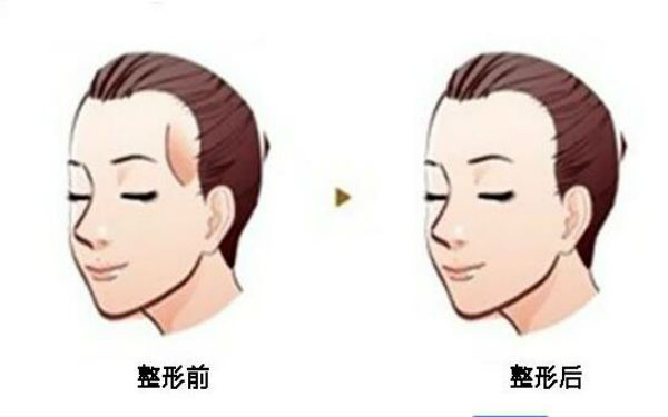 昆明外眼角上揚(yáng)術(shù)治療費(fèi)用一覽表查詢(2023昆明外眼角上揚(yáng)術(shù)參考價(jià)為：4572元)