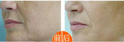 鄭州切眉手術(shù)治療價目表驚喜爆出(2023鄭州切眉手術(shù)參考價為：6941元)
