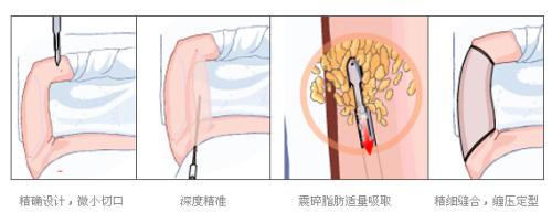 昆明內(nèi)窺鏡除皺祛抬頭紋的價(jià)錢(qián)一般要多少錢(qián)啊(2023昆明內(nèi)窺鏡除皺祛抬頭紋參考價(jià)為：4947元)