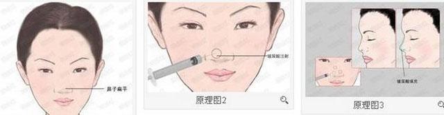 寧波消除面部皺紋術(shù)費(fèi)用2023預(yù)先一覽(2023寧波消除面部皺紋術(shù)參考價(jià)為：6462元)
