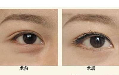 成都提眉眼袋費用是多少　(2023成都提眉眼袋參考價：4887-6298元)