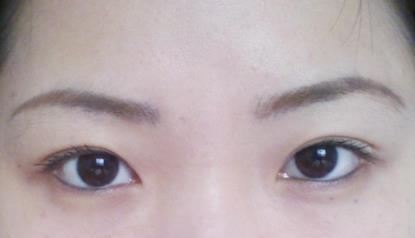 無(wú)錫假體隆鼻修復(fù)的價(jià)格是多少明細(xì)(2023無(wú)錫假體隆鼻修復(fù)參考價(jià)：4259-7454元)