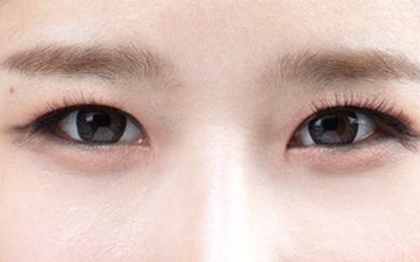 成都眼睛細(xì)紋消除大概費(fèi)用參考(2023成都眼睛細(xì)紋消除參考價：3571-6186元)