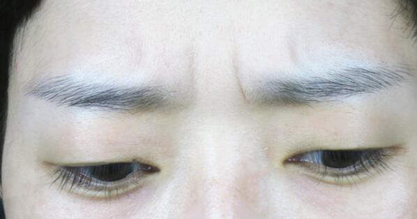 西安眼袋切除術(shù)收費(fèi)價(jià)格表剖析(2023西安眼袋切除術(shù)參考價(jià)：4886-6138元)