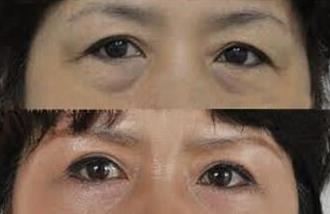 北京隆鼻術(shù)前須知，本地達人整理推薦的技術(shù)排行榜top5醫(yī)生