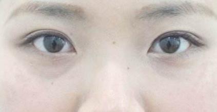 哈爾濱藝星整形醫(yī)院專業(yè)雙眼皮技術(shù)解析：鄭皓均醫(yī)生的創(chuàng)新術(shù)獲贊