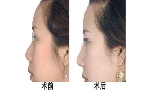 南京四位雙眼皮修復(fù)醫(yī)生：管勇智、彭超、郭宗科，馬秀云的真實案例揭秘