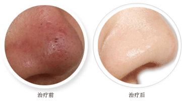 2023上海超聲刀祛疤top10強(qiáng)醫(yī)生排名戳進(jìn)來(lái)看詳情！楊群、胥肖琴、馬曉蓬破格入圍