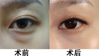 2023湖南激光生長(zhǎng)紋正規(guī)醫(yī)生口碑十強(qiáng)實(shí)時(shí)更新！黃妹、蘇朝陽(yáng)、蔣巧麗實(shí)力口碑都很強(qiáng)