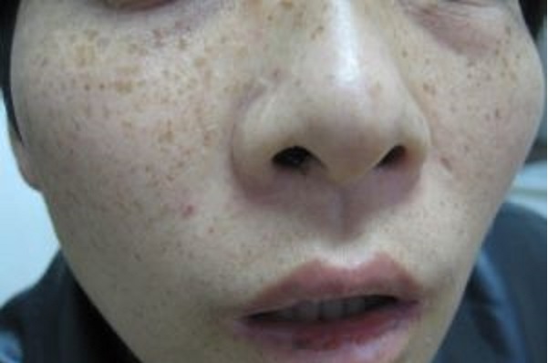 2023合肥乳房雙側(cè)注射吸脂醫(yī)生排行前十整友力薦！廖亞敏、朱祖俊、陳錄翔強(qiáng)勢(shì)領(lǐng)銜