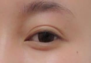 白天是誰(shuí)開的睜眼儀+手術(shù)怎么做，你怎么看？簡(jiǎn)介+美眼記錄為參考