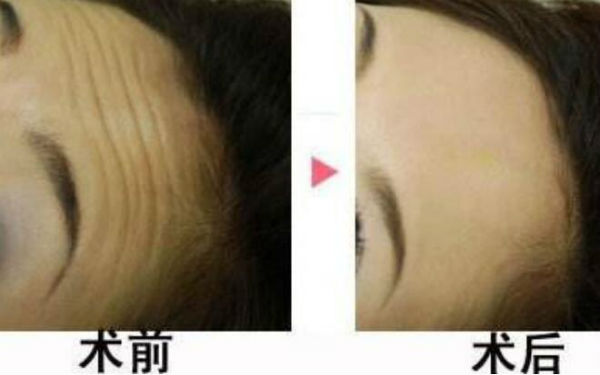 2023成都自體脂肪豐太陽穴醫(yī)生top10排行榜都是哪些機構(gòu)？劉東明、楊海波、向維收費都不貴的