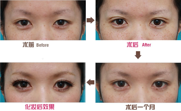 北京知名雙眼皮修復(fù)醫(yī)生推薦名單，2023最新版本+王世勇技術(shù)案例分享
