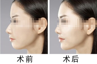 上海潔銘醫(yī)療美容劉志欣抽脂專家解析：抽脂術前必讀