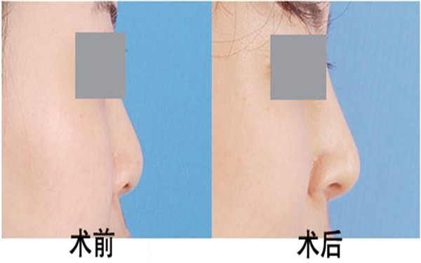 半永久紋發(fā)際線技術史三八醫(yī)療美容醫(yī)院首席專家李珠賢創(chuàng)新方案