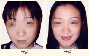 深圳修復(fù)雙眼皮哪家醫(yī)生好？網(wǎng)友推薦排行榜前五，特點(diǎn)和價(jià)目一覽