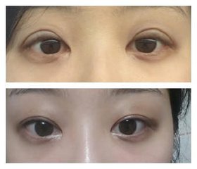 揭秘！鄭州哪里的假體隆胸技術比較好？3位有口碑的專家推薦及價格一覽！