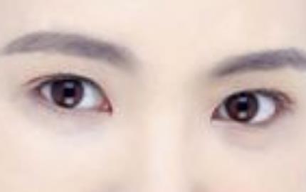 四川友誼醫(yī)院雷蕾醫(yī)生的雙眼皮技術(shù)與醫(yī)療服務(wù)如何？