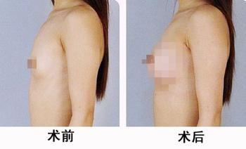 哈爾濱藝星整形醫(yī)院推出高效術(shù)后吸脂技術(shù)，洪潤(rùn)基韓式分層吸脂面世惹人期待