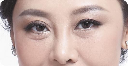 上海美未央整形醫(yī)院袁磊割雙眼皮效果怎么樣