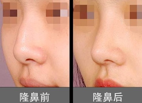 河南鄭州哪位醫(yī)生擅長鼻部整形手術(shù)？5位專家醫(yī)師實力強悍，價格表詳解！