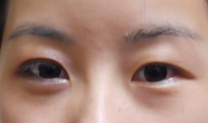 武漢同濟醫(yī)院吳敏如何為我雙眼打造完美翻頁？醫(yī)生介紹+親身體驗，告訴你我的美麗之旅！