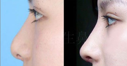 長沙孫玥玥與張姣姣：哪位整形醫(yī)生更勝一籌？揭秘雙眼皮科普與優(yōu)勢