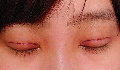 國內(nèi)脂肪填充專家，大揭秘醫(yī)生排行榜單及費用參考
