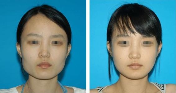 上海隆鼻重量級(jí)揭曉！前五位專家身份曝光，你不得不知！