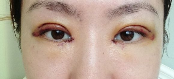 青島瑞霞做雙眼皮，往何處尋找經(jīng)驗？