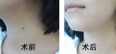 北京禾美嘉任學(xué)會(huì)豐胸效果如何？整形手術(shù)費(fèi)用一覽及最新價(jià)格