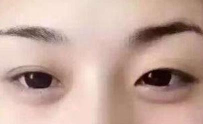 王義山整形雙眼皮修復(fù)效果如何？詳細(xì)介紹醫(yī)生信息、費(fèi)用和就診地點(diǎn)