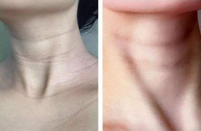 上海九院整形外科胡曉潔醫(yī)生精準切除腫瘤的方法與效果如何？