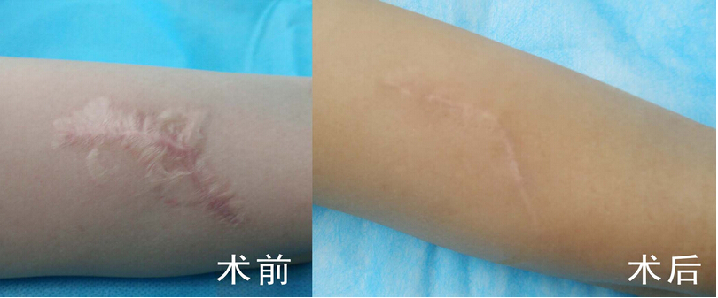武漢五洲整形：費德洲醫(yī)生禿頂植發(fā)后3個月果效如何？
