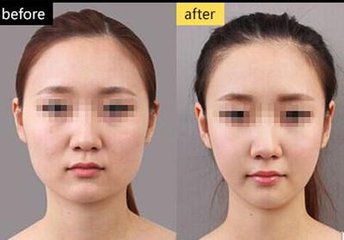 楊勝發(fā)醫(yī)生雙眼皮手術如何？探秘楊勝發(fā)醫(yī)生的雙眼皮經(jīng)歷，帶你實地了解“baby小鹿眼”手術效果！
