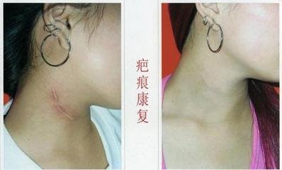 西寧碧蓮盛移植術(shù)如何？醫(yī)生介紹+種植經(jīng)驗(yàn)分享