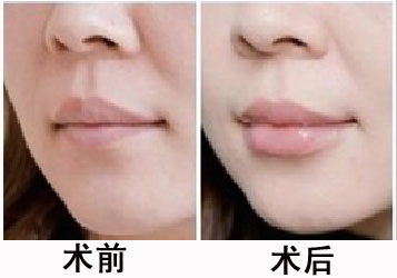 廣州南方醫(yī)院整形外科醫(yī)生資歷揭秘，并分享真實(shí)開眼角案例驚人反饋